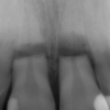 xray of broken teeth