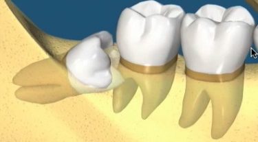 wisdom teeth impacted recommended for extraction by oral surgeon