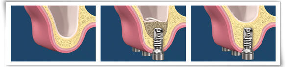 sinus lift bone graft oral surgeon bethesda