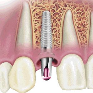 dental implant in the smile zone by dr. hamid ryan kazemi oral sureon bethesda, MD