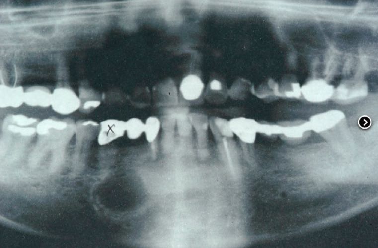 Lower Jaw Cyst | Lower Jaw Cyst - Kazemi Oral Surgery | Facialart.com
