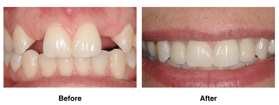 Missing upper lateral incisors replaced with dental implants