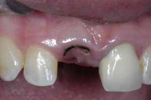 severe caries upper incisor