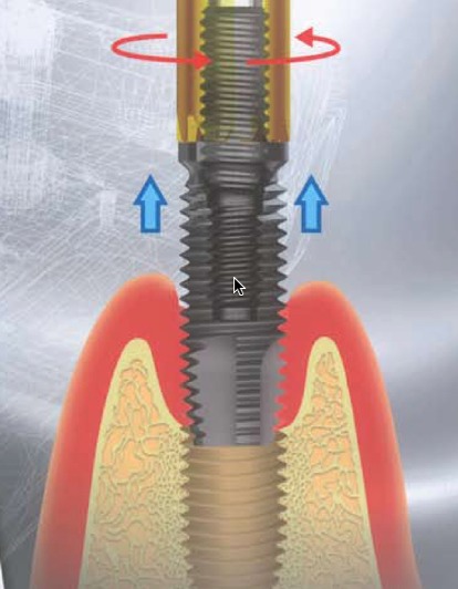 dental implant removal kit