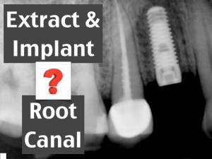 root canal or extract and dental implant