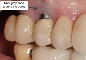 Dark area around dental implant