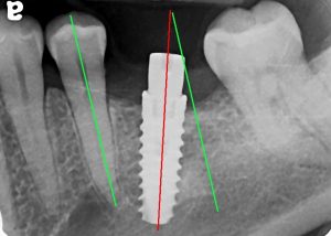 Dental implant in bad position
