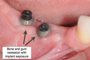 Implant exposure from recession