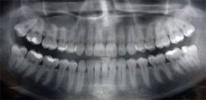 Panoramic X-Ray