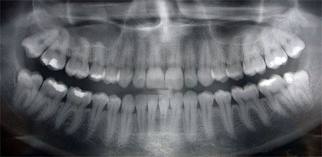 Panoramic X-Ray