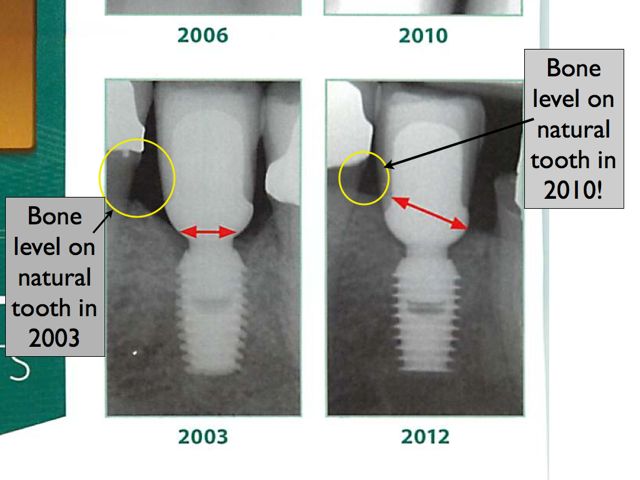 Bicon dental implants
