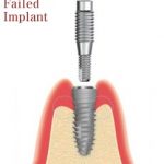 removal of failed dental implants
