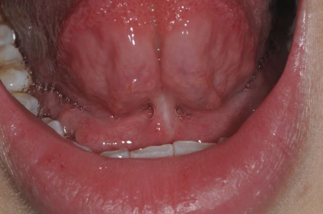 Tongue tie (ankyloglossia)