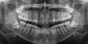impacted wisdom teeth close to nerve