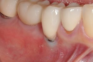 Dental implant with peri-implantitis due to poor implant position and implant surface exposure