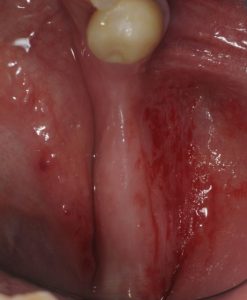 AR- Thin ridge and bone loss for dental implants