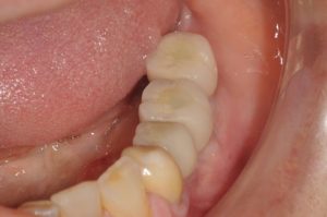 Bone was augmented with grafting. Then restored with three dental implants and single crowns.