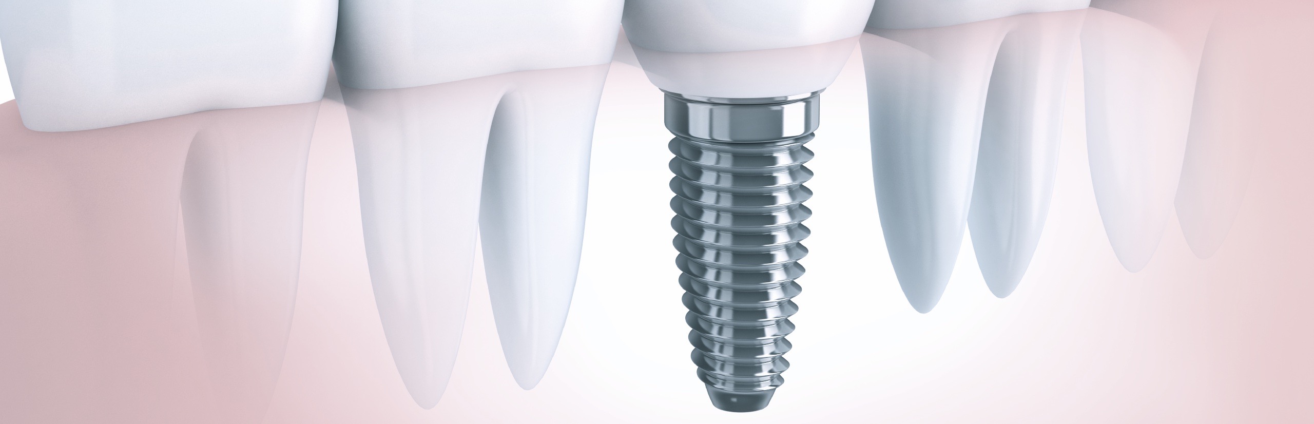 Dental-implants-complications1.jpg