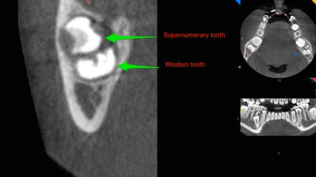 CBCT super numerary impacted wisdom tooth