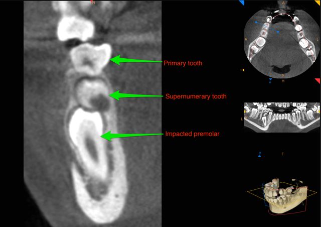 CBCT supernumerary impacted premolar