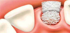 best extraction site bone grafting course bethesda oral surgeon