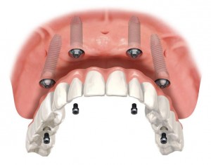 fixed hybrid-teeth supported by dental implants oral surgeon bethesda