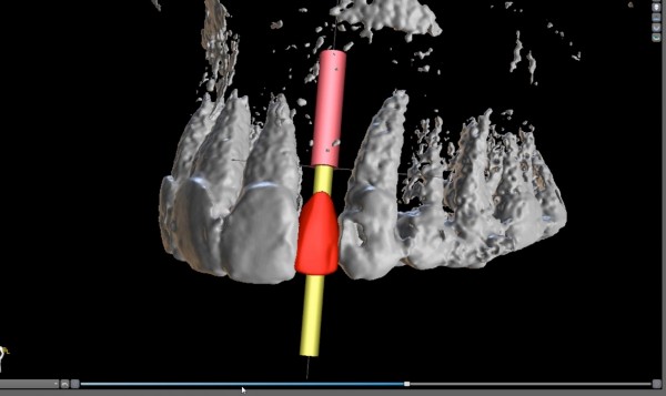 3-d computer assisted planning for implant lateral incisor digital waxup and implant position kazemi oral surgery bethesda
