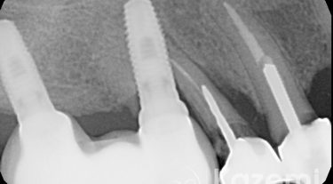 Dental implant complications