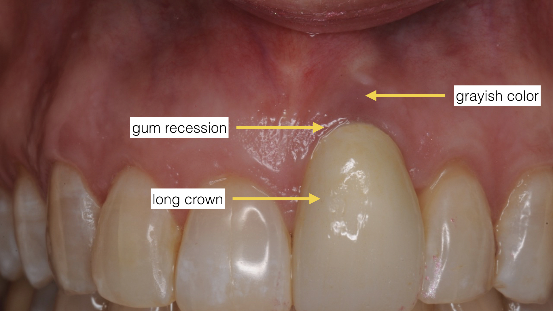 Do Gums Grow Back After Dental Implant?