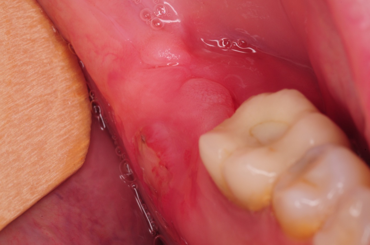 Poking of gum tooth through Finding A