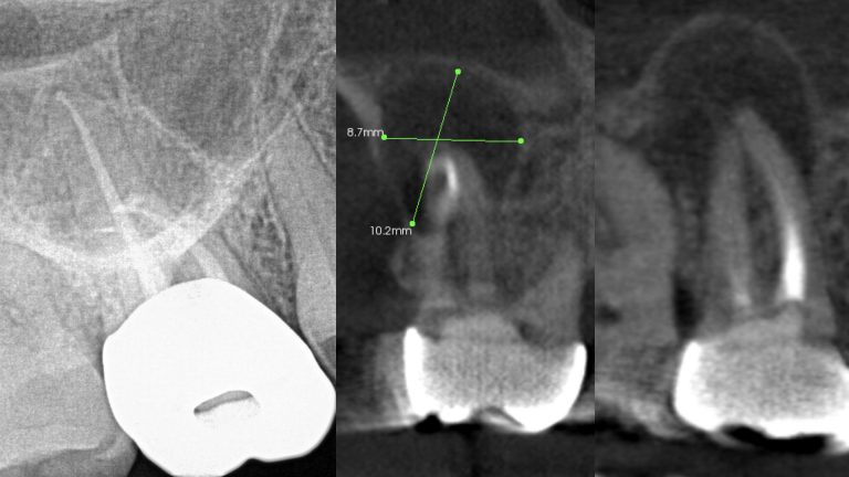 Periapical X Ray Cone Beam Ct Scan Cbct Lesion Of Endodontic Origin