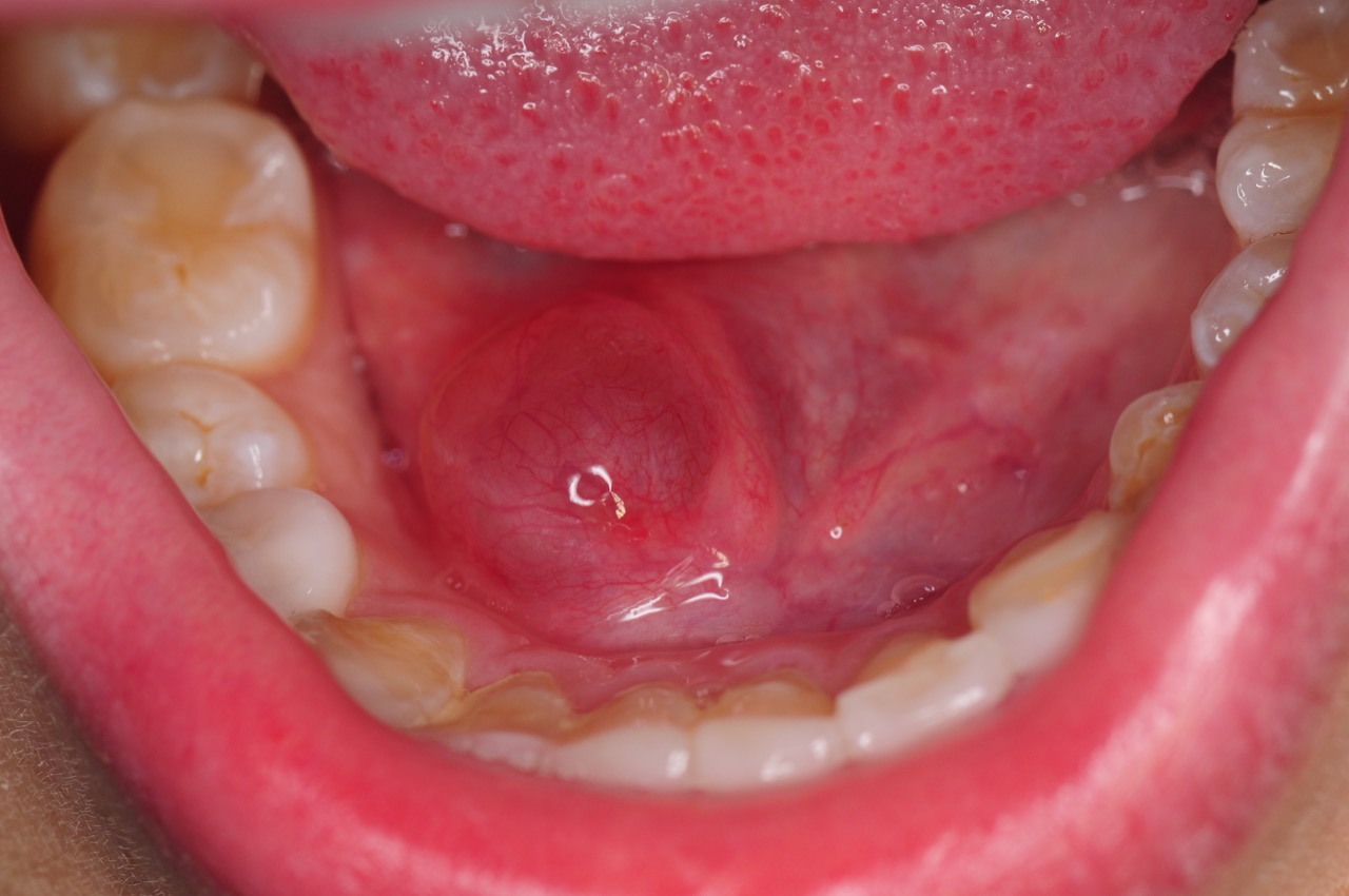 ranula marsupialization floor of mouth kazemi oral surgery bethesda MD 1 ranula