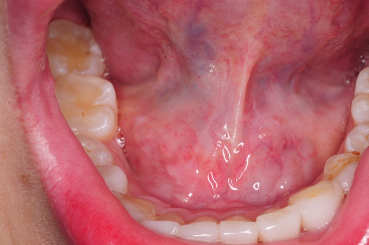 Swelling Related to Ranula Under The Tongue Swelling Related to Ranula Under The Tongue