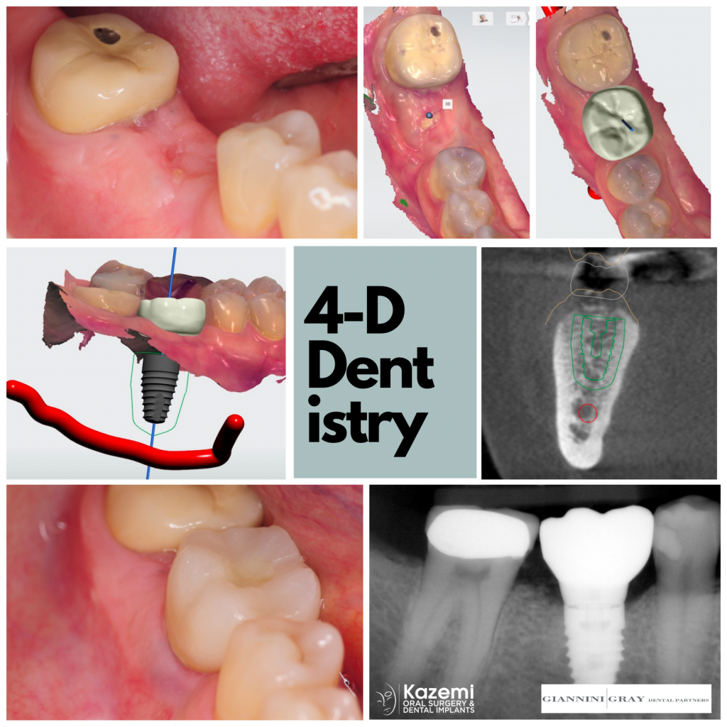 demonstrate digital dentistry and dental implant planning to replace a missing molar and achieve a natural looking result