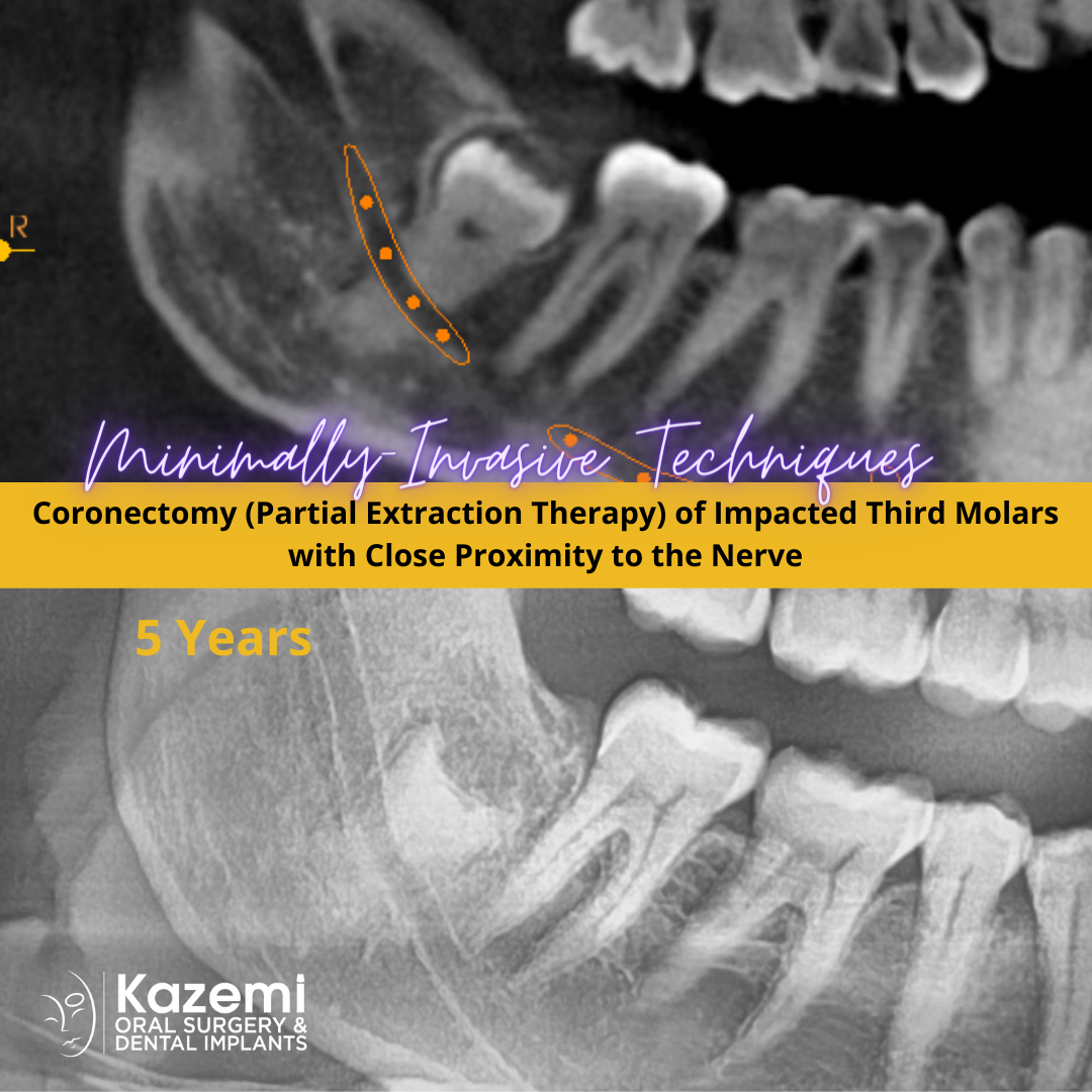Coronectomy Partial Extraction Therapy Of Impacted Wisdom Teeth Close
