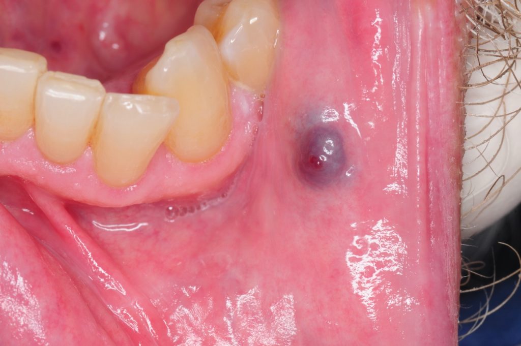 Oral Hemangioma Appearing As A Blue Purple Lesion Oral Hemangioma