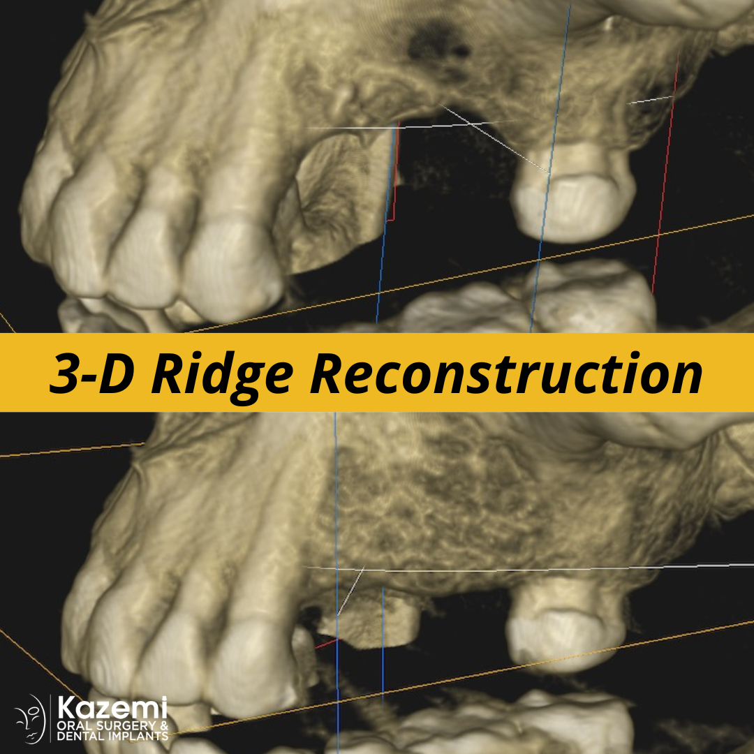 A Second Chance to Savor Life: Dental Implants, Ridge Bone Grafting ...