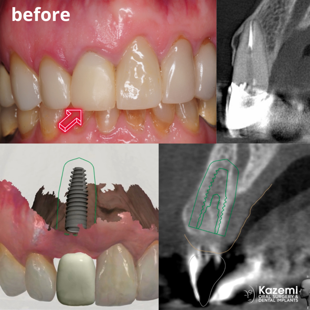 dental implant challenges in the smile zone upper front area with best cosmetic result
