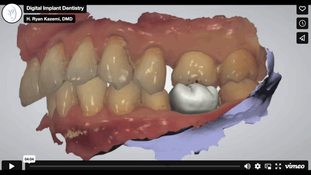 digital dental implant planning and dental implant placement with surgical guide