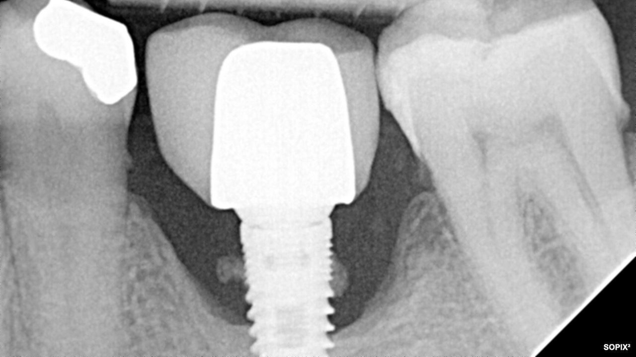 Chronic Low-Grade Pain Around Dental Implants: Why Early Action