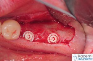 Zirconia dental implants placed with Z-systems surgical instrumentation.