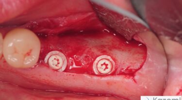 Zirconia dental implants placed with Z-systems instrumentation.
