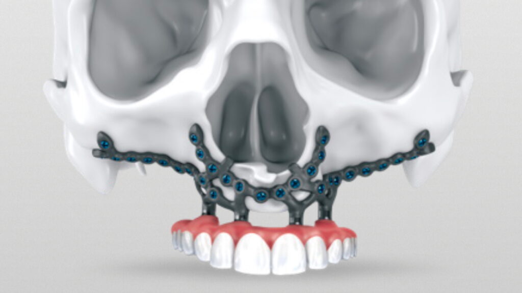 no bone for dental implants IPS preprosthetic implant