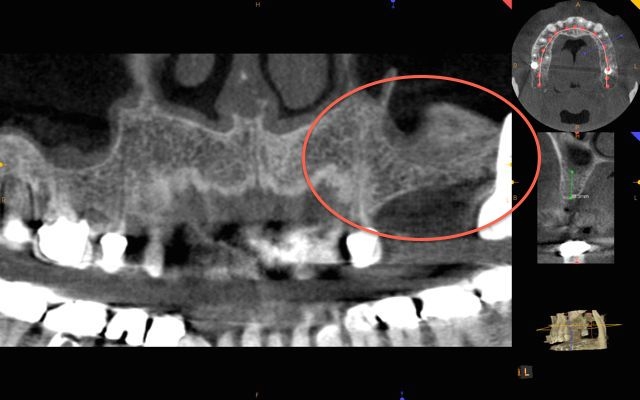 CBCT post sinus lift kazemi oral surgery bethesda