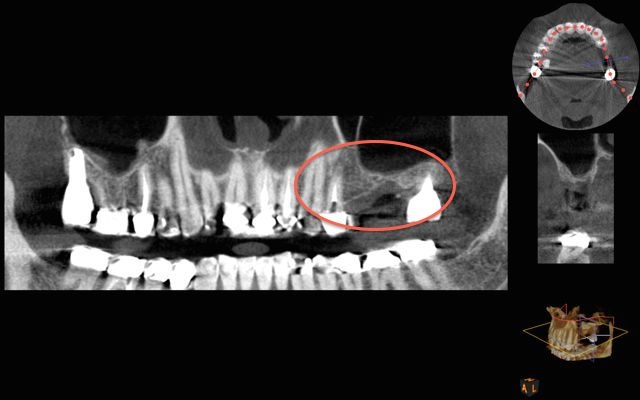 dental CT scan sinus lift graft kazemi oral surgery