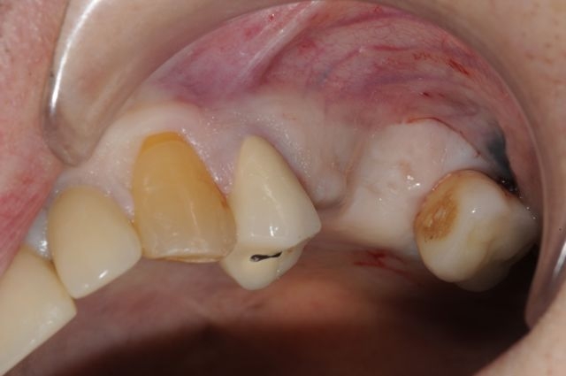 missing teeth sinus and ridge defect