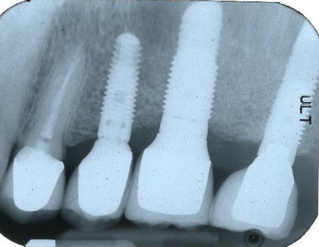 sinus lift bone graft implants final x-ray