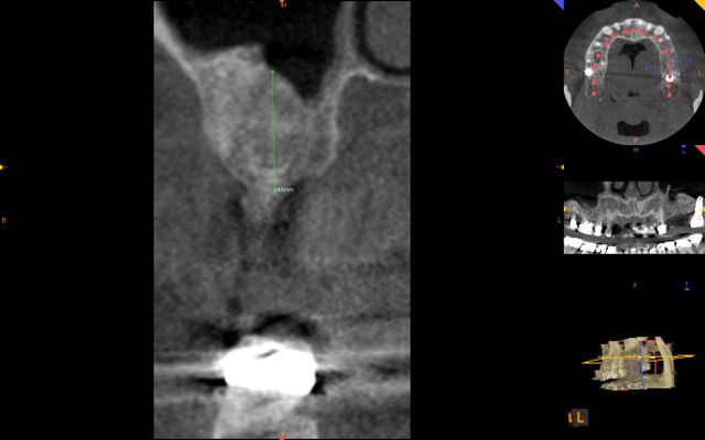 sinus lift bone graft kazemi oral surgery post op xray
