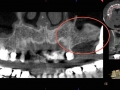 CBCT post sinus lift kazemi oral surgery bethesda