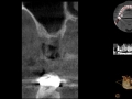 Cone beam ct scan sinus lift preop xray